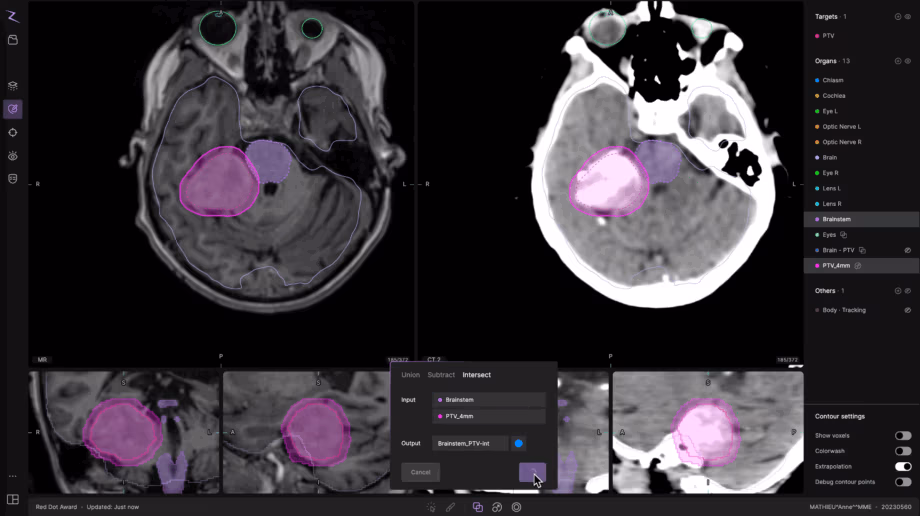Screenshot of the ZAP-Axon® radiosurgery treatment planning software showing multi-planar MRI and CT image views of a brain case. The interface displays color-coded contour outlines for target and organ structures, including the PTV (pink) and brainstem (purple), with overlapping regions highlighted. The user is performing an “Intersect” operation between the Brainstem and PTV_4mm volumes in the contour editing panel. The right-hand panel lists anatomical structures such as optic nerves, eyes, cochlea, and chiasm, while lower panels show sagittal, coronal, and axial slices. The ZAP-Axon® platform integrates multimodal imaging for precision radiosurgical planning in ZAP-X® treatments.