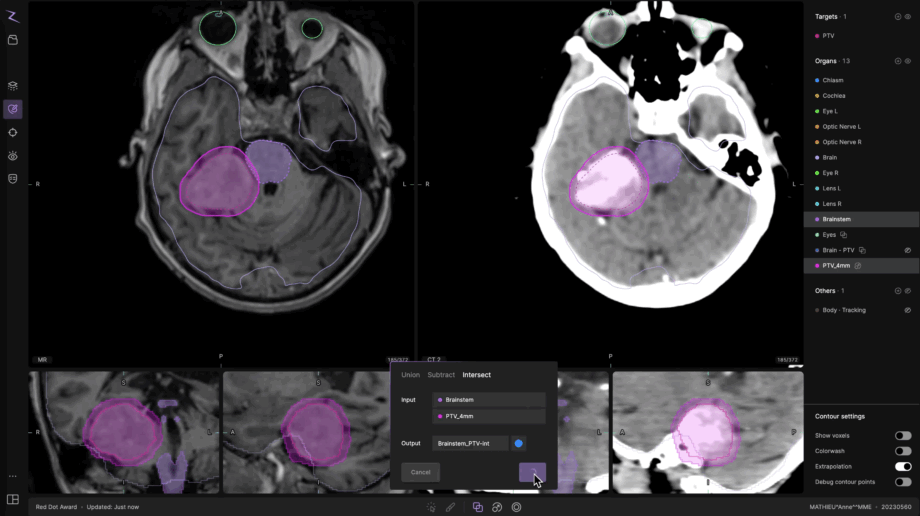 Screenshot of the ZAP-Axon® radiosurgery treatment planning software showing multi-planar MRI and CT image views of a brain case. The interface displays color-coded contour outlines for target and organ structures, including the PTV (pink) and brainstem (purple), with overlapping regions highlighted. The user is performing an “Intersect” operation between the Brainstem and PTV_4mm volumes in the contour editing panel. The right-hand panel lists anatomical structures such as optic nerves, eyes, cochlea, and chiasm, while lower panels show sagittal, coronal, and axial slices. The ZAP-Axon® platform integrates multimodal imaging for precision radiosurgical planning in ZAP-X® treatments.