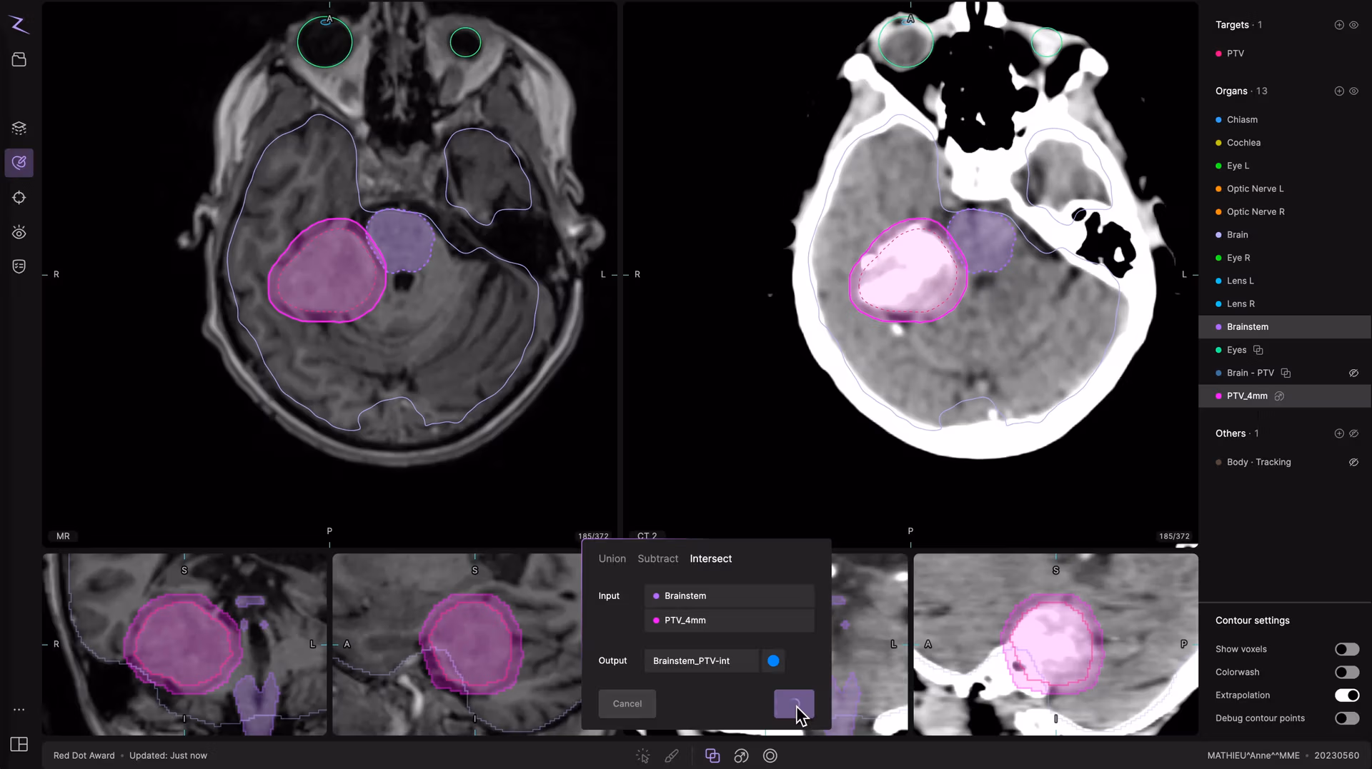 Screenshot of the ZAP-Axon® radiosurgery treatment planning software showing multi-planar MRI and CT image views of a brain case. The interface displays color-coded contour outlines for target and organ structures, including the PTV (pink) and brainstem (purple), with overlapping regions highlighted. The user is performing an “Intersect” operation between the Brainstem and PTV_4mm volumes in the contour editing panel. The right-hand panel lists anatomical structures such as optic nerves, eyes, cochlea, and chiasm, while lower panels show sagittal, coronal, and axial slices. The ZAP-Axon® platform integrates multimodal imaging for precision radiosurgical planning in ZAP-X® treatments.