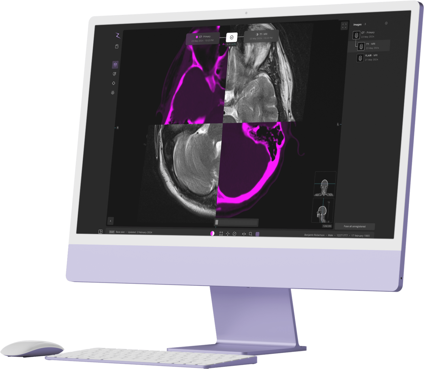 ZAP-AXON® - Radiosurgery Planning System (Axon)
