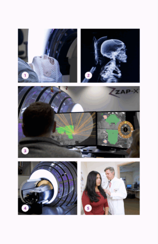 ZAP-X Treatment Overview (5 Images) • Image 1: Patient wearing a mesh thermoplastic mask while lying down on the ZAP-X treatment table, with the ZAP-X machine visible in the background. • Image 2: Computer screen displaying a 3D scan of a patient’s head, used for precise targeting in ZAP-X radiosurgery. • Image 3: Two clinicians reviewing a multi-screen display showing ZAP-X treatment planning software, with the ZAP-X logo visible on the wall. • Image 4: ZAP-X radiosurgery machine with its distinctive circular design, shown with a patient positioned on the treatment table. • Image 5: Doctor in a white coat using a stethoscope while consulting with a patient in a clinical setting.